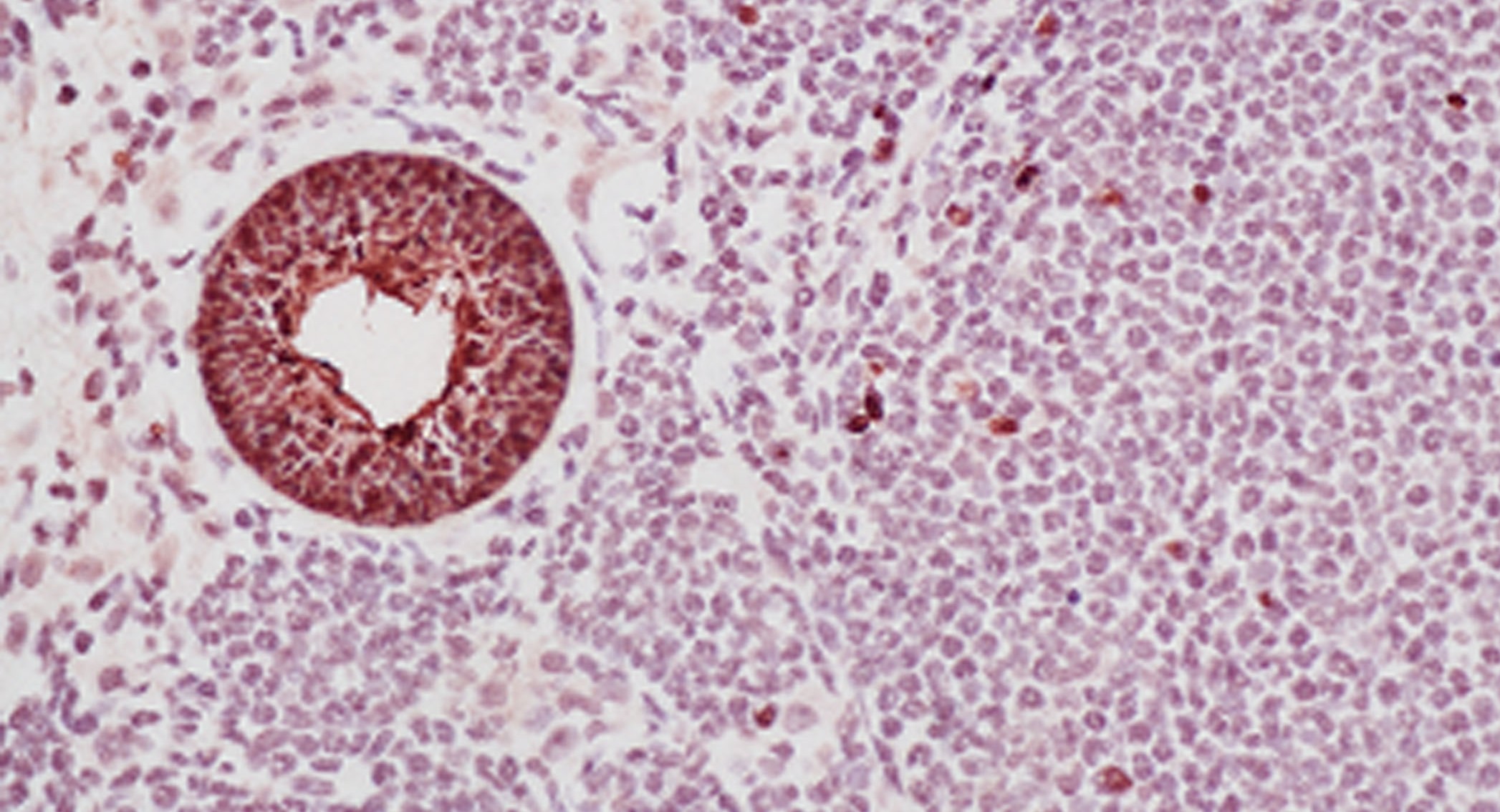 Valley Fever spherule in lung